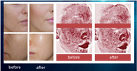 Salon Mesotherapy Iniezione Pdrn Acido ialuronico Soluzione complessa per il ringiovanimento della pelle