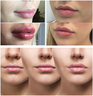 Linee regolari/labbra grassottelle con il riempitore iniettabile acido ialuronico 1ml 2ml 5ml