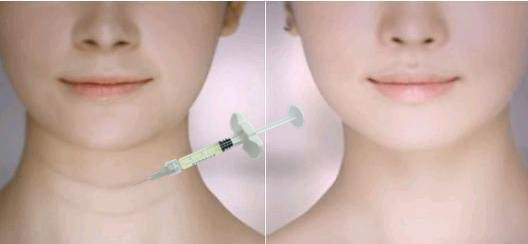 Raggiungere labbra più belle con riempitivi per labbra cutanei