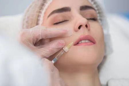 Imballaggio della siringa Acido ialuronico per le rughe Riempitore nasale, gel iniettabile di acido ialuronico