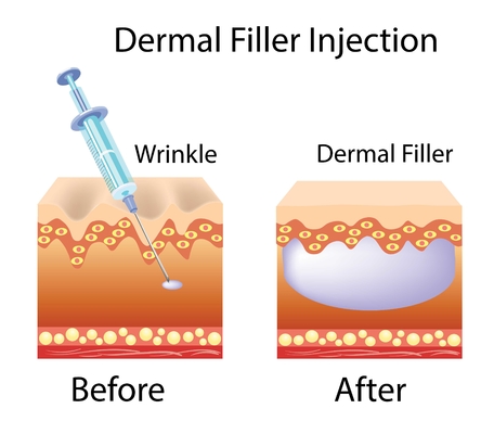 Produttore di filler per acido ialuronico Gel per viso e corpo a base di ialuronato di sodio modificato iniettabile