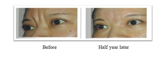 350 mg 150 mg PLLA Poly L Lattic Acid Dermal Filler Per il Trattamento delle Rughe Faciali