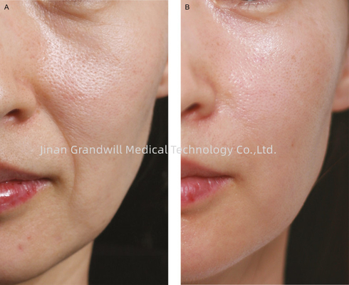 Miracle H L PCL Skin Booster Fino Linea Policaprolactone Acido Ialuronico Iniezione Riempitore