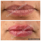 Iniezioni di acido ialuronico per labbra Riempitivi per labbra di aspetto naturale Ingrandimento della labbra non chirurgico