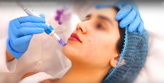 riempitore cutaneo acido ialuronico dell'iniezione collegato incrocio puro 20mg di 10ml 100% non per la penna di derma