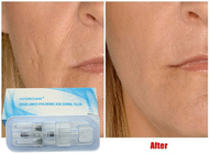 Riempitore iniettabile acido ialuronico 10ml per le guance Chin Augmentation dell'iniezione del labbro