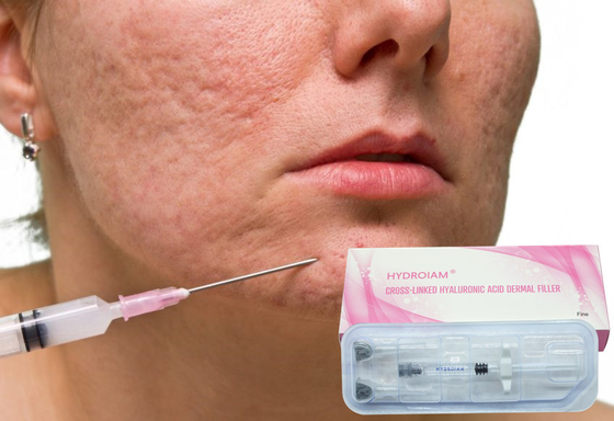 iniezione del gel di Hyaluronate del sodio 1ml per l'eliminazione delle grinze facciali fini