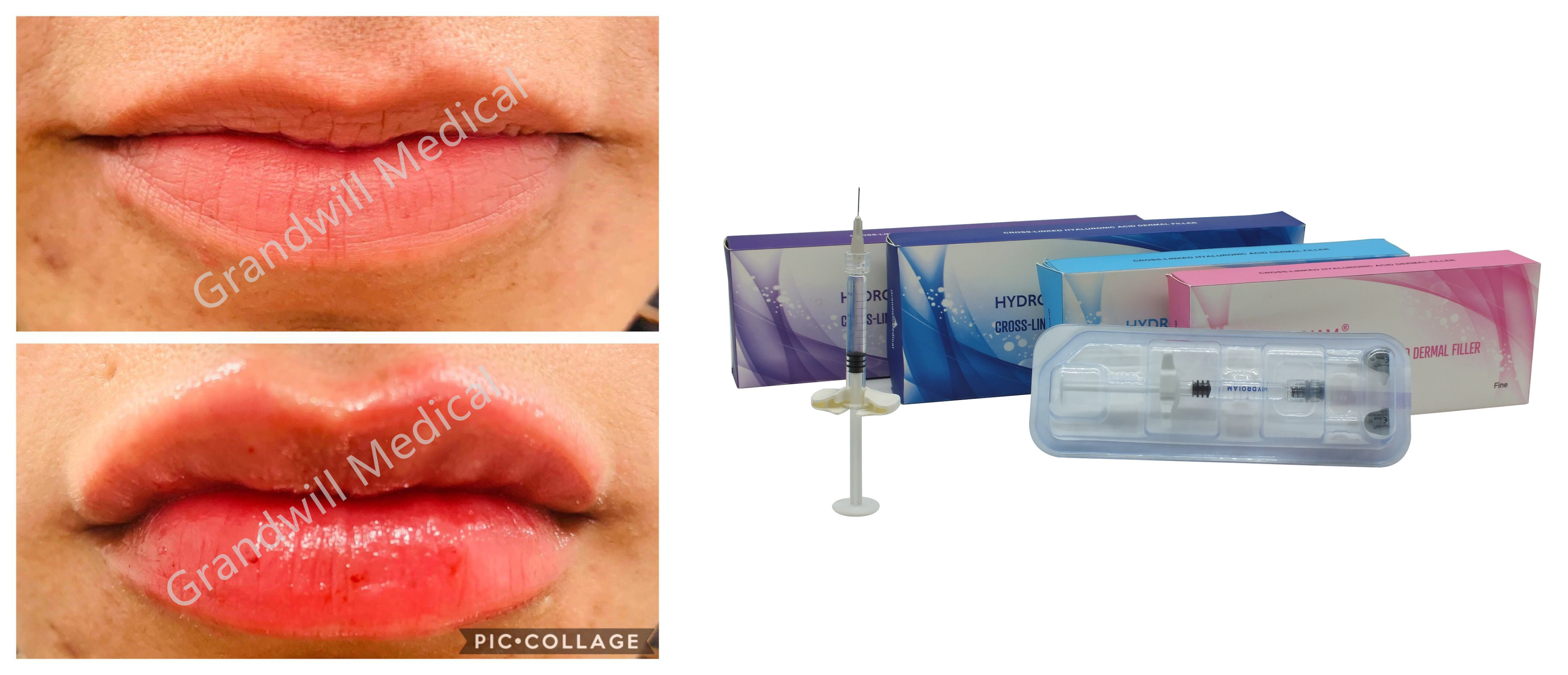 Riempitore cutaneo acido ialuronico collegato trasversale dell'iniezione del sodio per le grinze facciali di pienezza del labbro