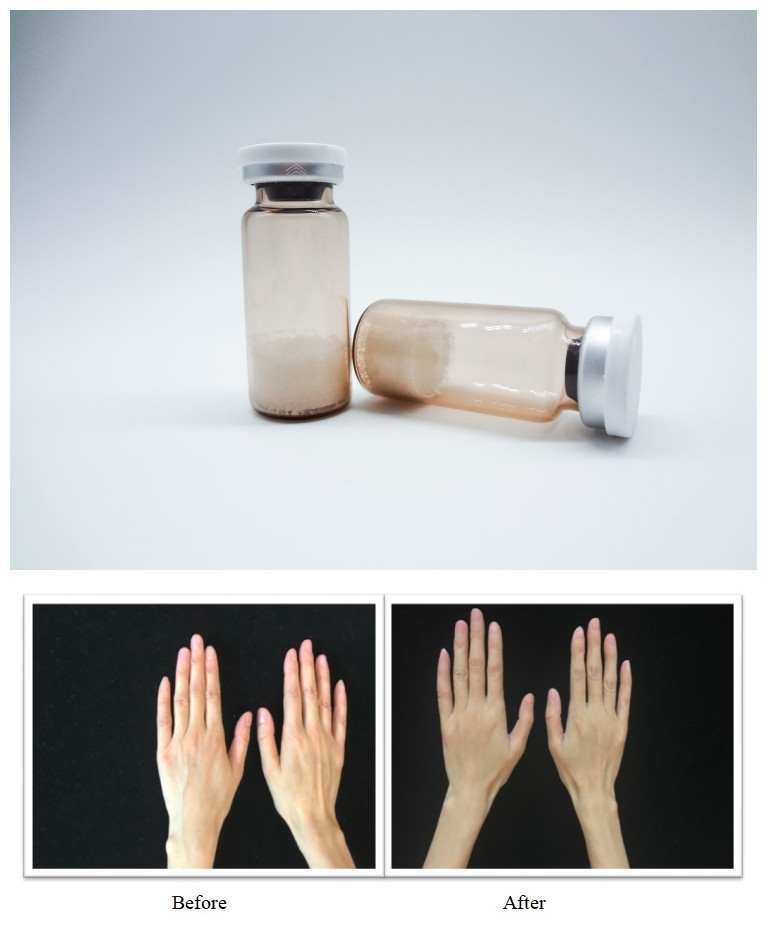 Iniezioni di gel di acido ialuronico PLLA progettato per correggere lisce le rughe e ripristinare il volume facciale