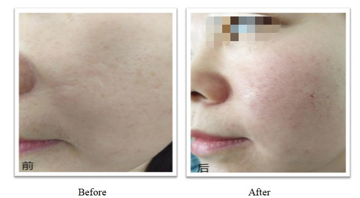 350 mg 150 mg PLLA Dermal Filler OEM Personalizzazione Plla iniettabile Per risultati duraturi